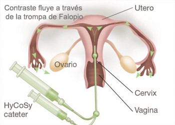 Diagrama Histerosalpingografía (HSG)