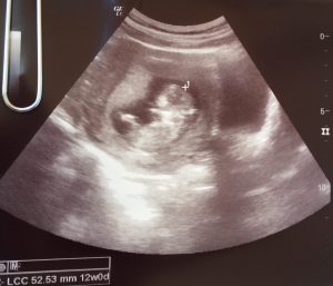 Tercera ecografía - 12 semanas, mi bebé se mueve